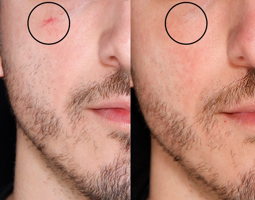 Фотоомоложение лица и кожи аппаратом Lumeca | Оренбург